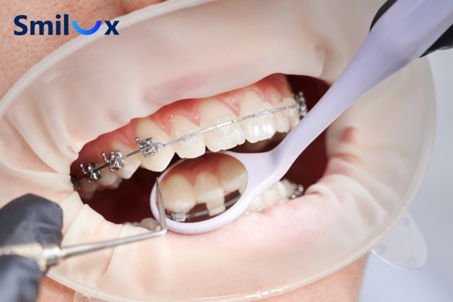 40 tuổi có niềng răng được không? Câu trả lời là CÓ 40 tuổi có niềng răng được không? Câu trả lời là CÓ