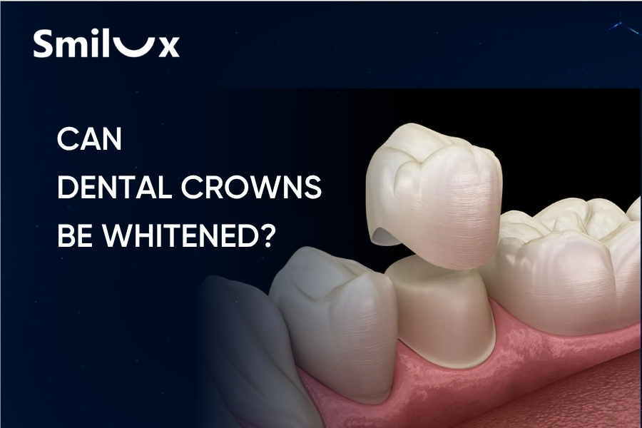 Can Dental Crowns Be Whitened? Smilux Dentist Explains in Detail