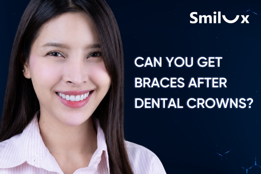 Can You Get Braces After Dental Crowns? Smilux dentists explain. Can You Get Braces After Dental Crowns? Smilux dentists explain.