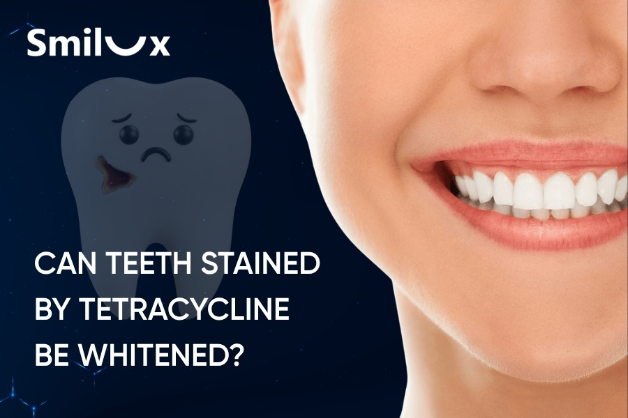 Can teeth stained by tetracycline be whitened? Can teeth stained by tetracycline be whitened?