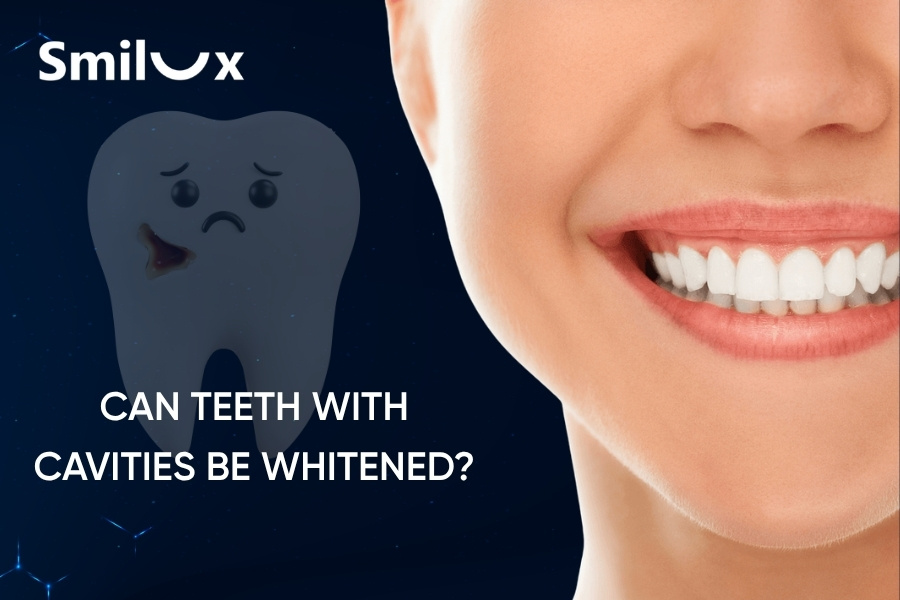 Can teeth with cavities be whitened? Is it effective and safe? Can teeth with cavities be whitened smilux