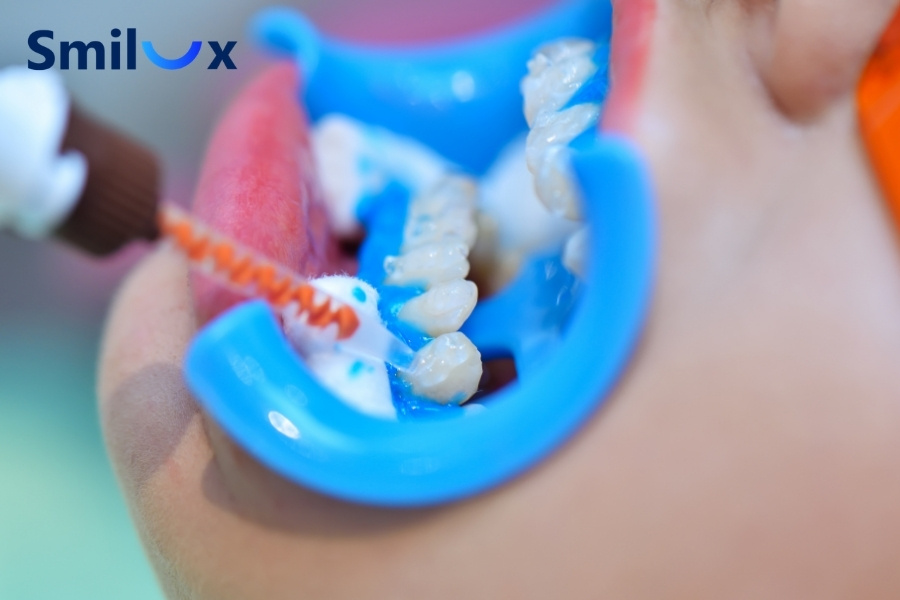 Không nên tẩy trắng răng sữa cho trẻ vì răng còn nhạy cảm, dễ ê buốt Không nên tẩy trắng răng sữa cho trẻ vì răng còn nhạy cảm, dễ ê buốt