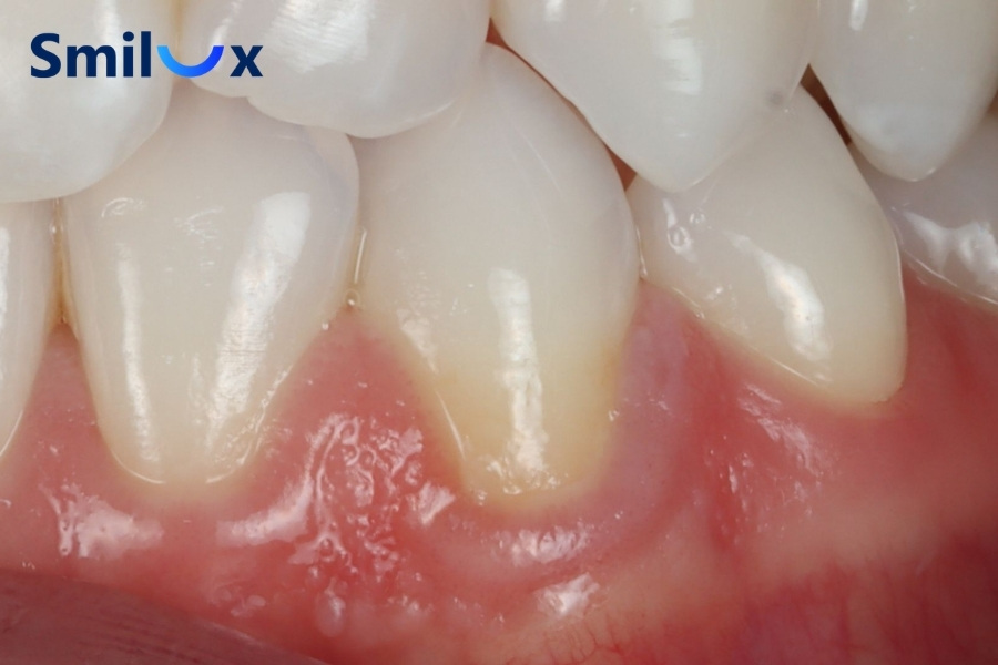 Dấu hiệu niềng răng bị tiêu xương Dấu hiệu niềng răng bị tiêu xương