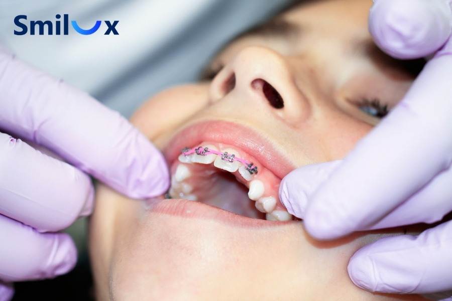 Độ tuổi vàng để niềng răng là từ 12 - 16 tuổi Độ tuổi vàng để niềng răng là từ 12 - 16 tuổi