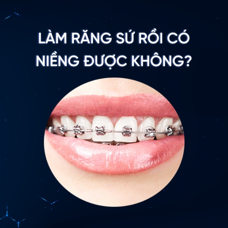 Làm răng sứ rồi có niềng được không smilux dental