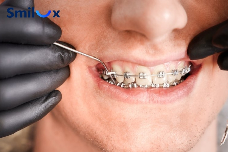 Người 40 tuổi niềng răng có lâu không? Người 40 tuổi niềng răng có lâu không?