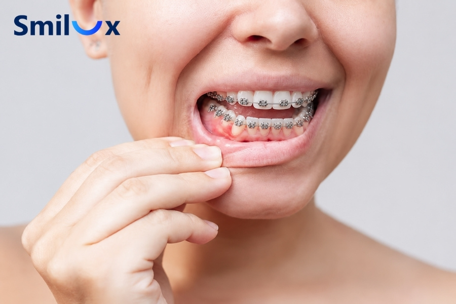 Niềng răng bị sưng nướu có nguy hiểm không? Niềng răng bị sưng nướu có nguy hiểm không?