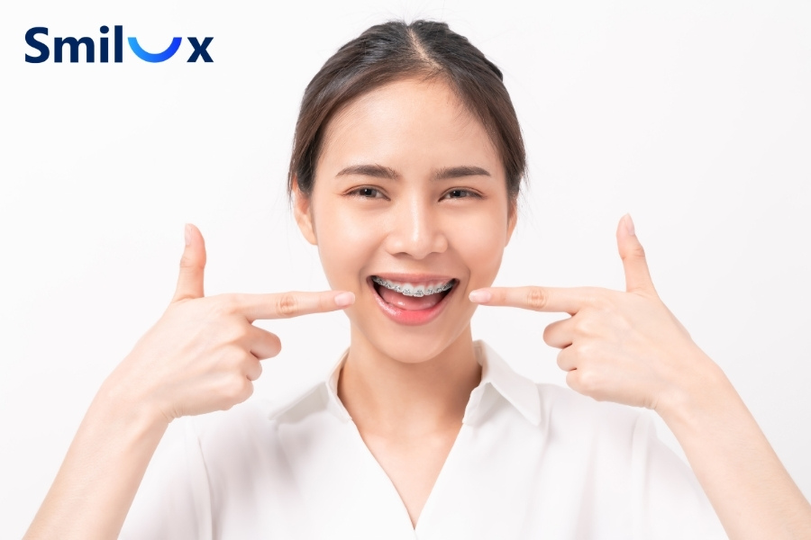 Niềng răng có đi bơi được không? Câu trả lời là CÓ Niềng răng có đi bơi được không? Câu trả lời là CÓ
