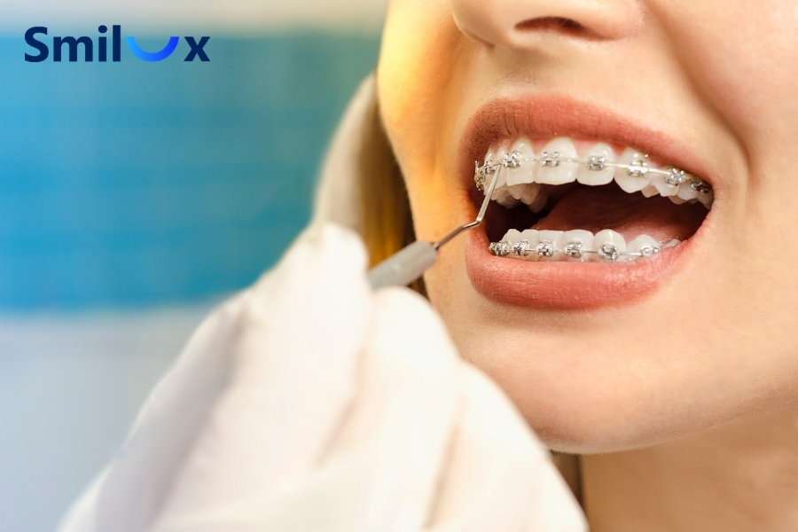 Niềng răng xong vẫn xấu nên thăm khám sớm để tìm nguyên nhân và xử lý đúng cách. Niềng răng xong vẫn xấu nên thăm khám sớm để tìm nguyên nhân và xử lý đúng cách.