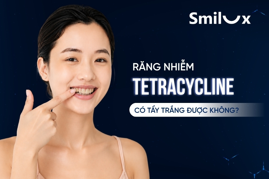 Răng nhiễm Tetracycline có tẩy trắng được không smilux dental