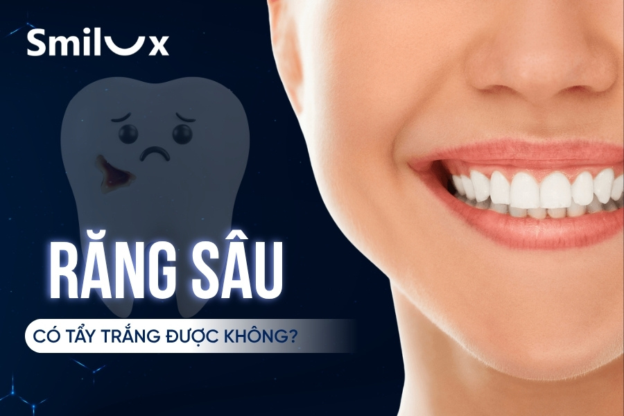 Răng sâu có tẩy trắng được không? Có hiệu quả và an toàn không?