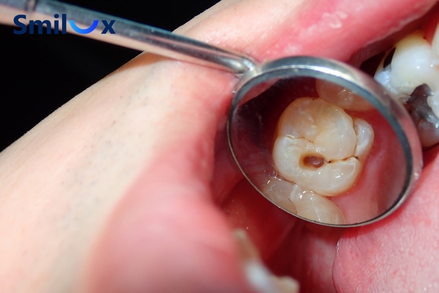 Răng sâu cần điều trị ổ viêm trước rồi mới tẩy trắng răng Răng sâu cần điều trị ổ viêm trước rồi mới tẩy trắng răng
