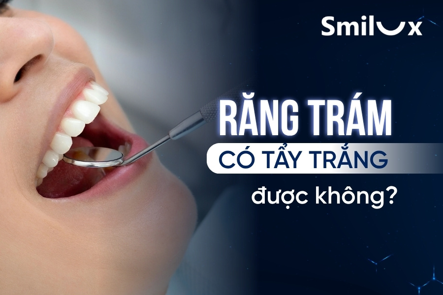 Răng trám có tẩy trắng được không? Tư vấn từ bác sĩ Smilux Dental Răng trám có tẩy trắng được không? Tư vấn từ bác sĩ Smilux Dental