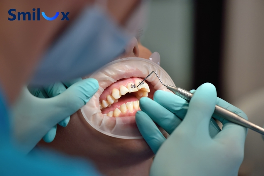 Chỉnh nha bị tiêu xương chủ yếu do tay nghề của bác sĩ Chỉnh nha bị tiêu xương chủ yếu do tay nghề của bác sĩ