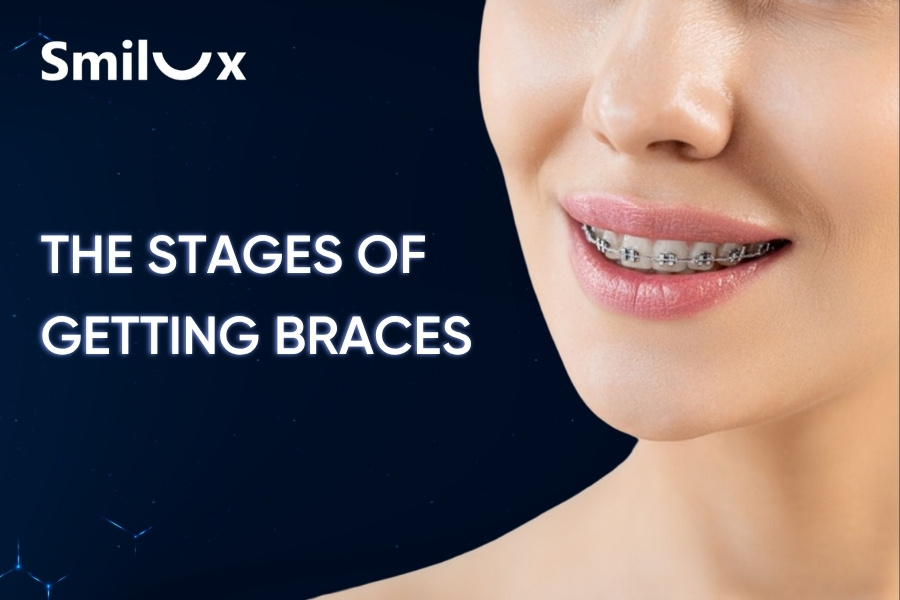 Learn About The Stages of Getting Braces in Detail - Smilux Dental Learn About The Stages of Getting Braces in Detail - Smilux Dental