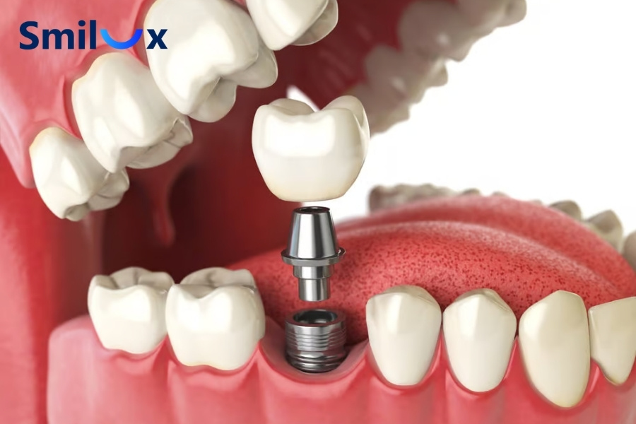 Trường hợp chỉ trồng 1 đến 2 răng Implant đơn lẻ, khách hàng vẫn có thể được cân nhắc niềng răng Trường hợp chỉ trồng 1 đến 2 răng Implant đơn lẻ, khách hàng vẫn có thể được cân nhắc niềng răng