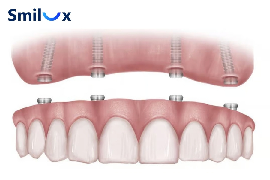 Implant toàn hàm All on 4 hoặc All on 6 không thể niềng Implant toàn hàm All on 4 hoặc All on 6 không thể niềng