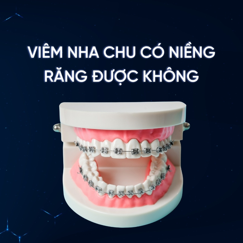 Người bị viêm nha chu có niềng răng được không? Smilux giải đáp