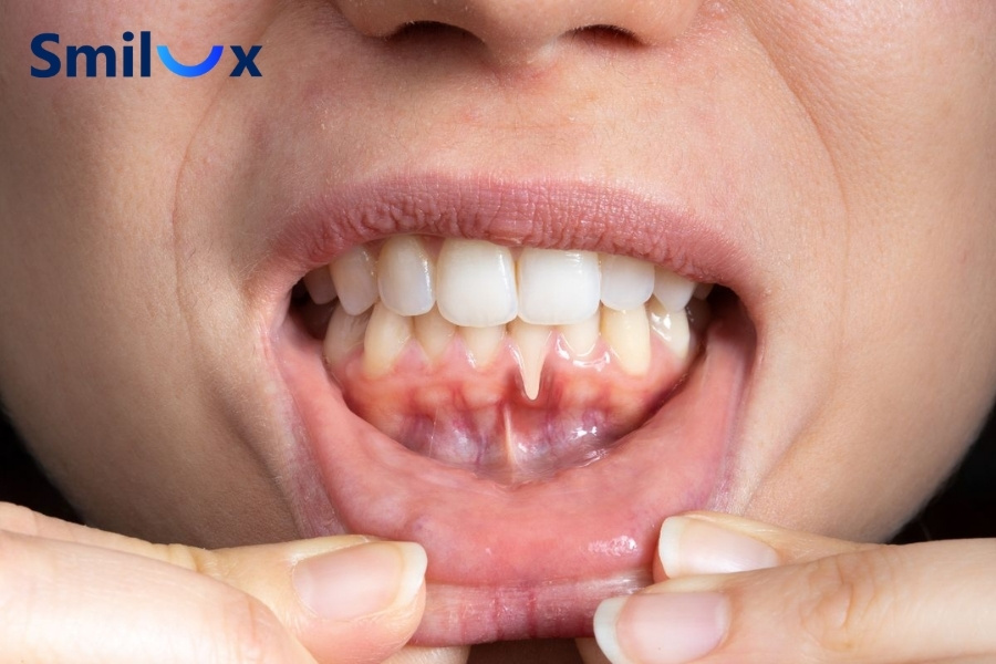 Bệnh nhân viêm nha chu vẫn có thể niềng răng Bệnh nhân viêm nha chu vẫn có thể niềng răng