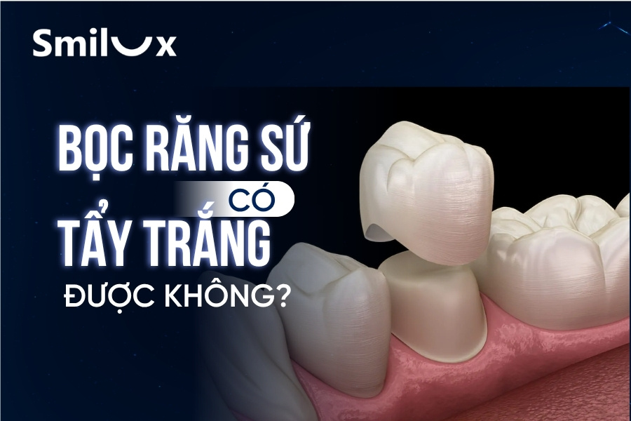 Bọc răng sứ có tẩy trắng được không? Bác sĩ Smilux giải đáp chi tiết Bọc răng sứ có tẩy trắng được không? Bác sĩ Smilux giải đáp chi tiết