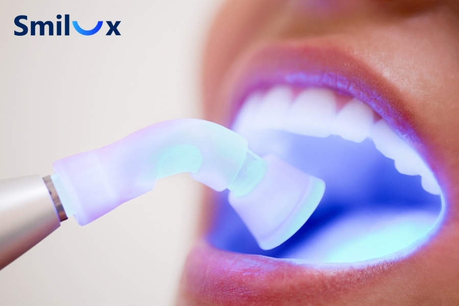 Miếng trám cũ hoặc răng sứ không đổi màu khi tẩy trắng, khiến răng thật và phục hình dễ bị lệch tông Miếng trám cũ hoặc răng sứ không đổi màu khi tẩy trắng, khiến răng thật và phục hình dễ bị lệch tông