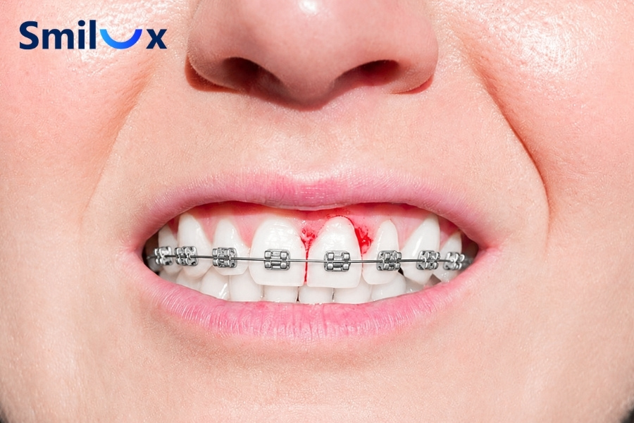 Niềng răng bị sưng nướu là tình trạng nướu quanh mắc cài bị viêm, sưng đỏ và dễ chảy máu. Niềng răng bị sưng nướu là tình trạng nướu quanh mắc cài bị viêm, sưng đỏ và dễ chảy máu.