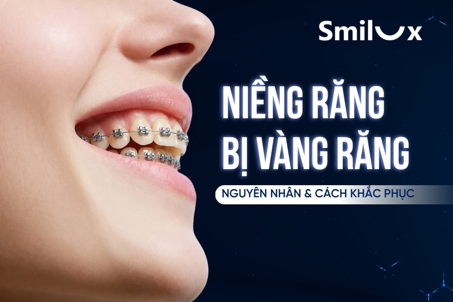 Niềng răng bị vàng răng: Nguyên nhân và cách khắc phục Niềng răng bị vàng răng: Nguyên nhân và cách khắc phục
