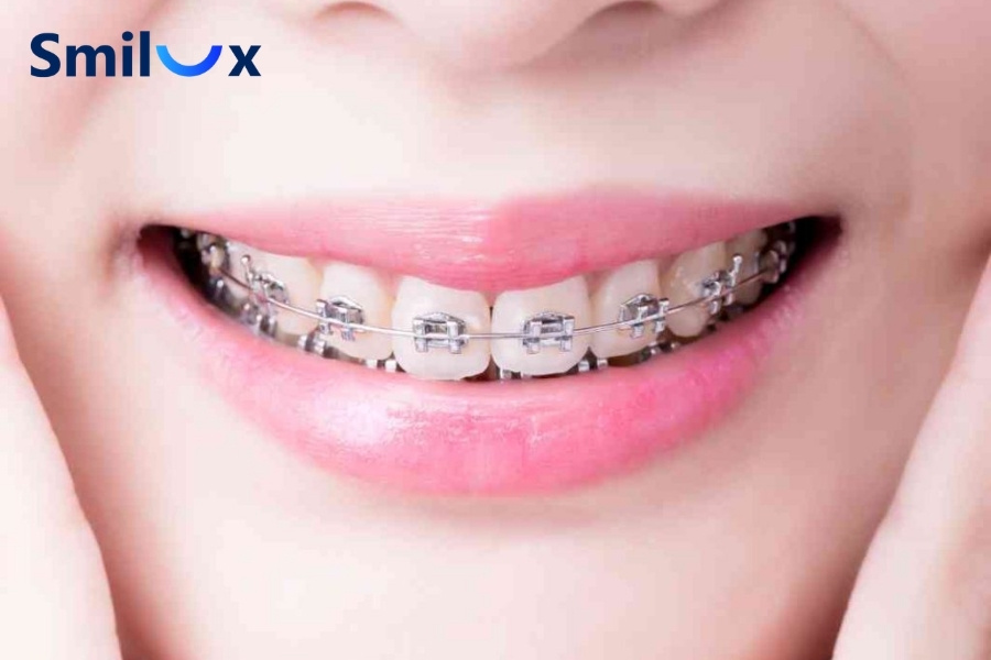 Niềng răng mắc cài kim loại Niềng răng mắc cài kim loại