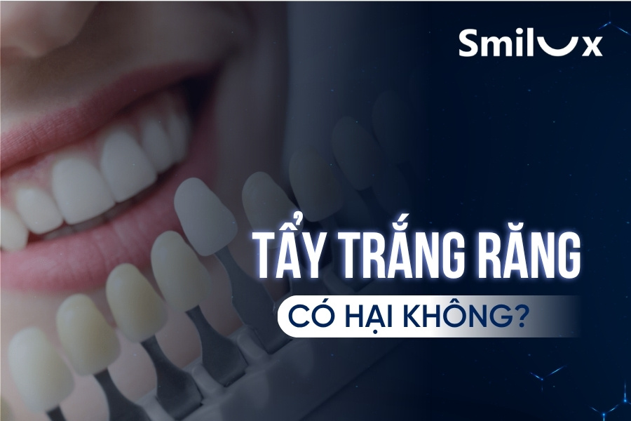 Tẩy trắng răng có hại không? Có nên đi tẩy trắng răng?