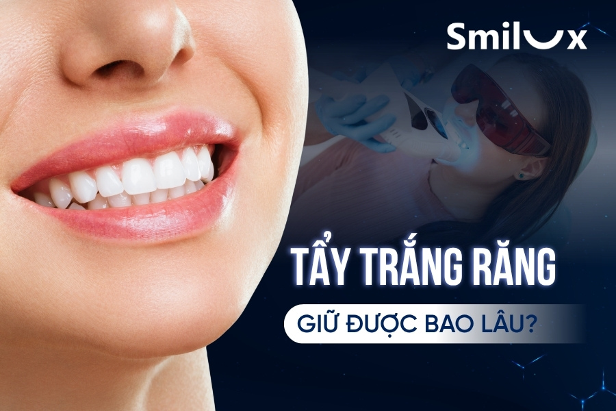 Tẩy trắng răng giữ được bao lâu? Bao lâu nên tẩy trắng răng 1 lần?