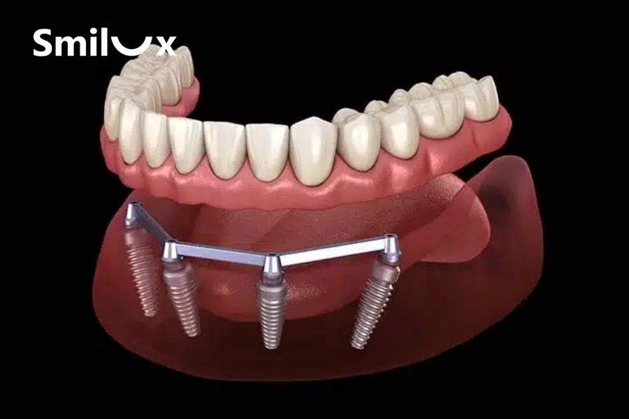 Hàm tháo lắp trên Implant có thanh bar Hàm tháo lắp trên Implant có thanh bar