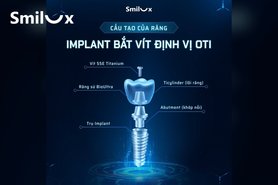 Cấu tạo răng implant tại nha khoa Quốc tế Smilux Dental Cấu tạo răng implant tại nha khoa Quốc tế Smilux Dental