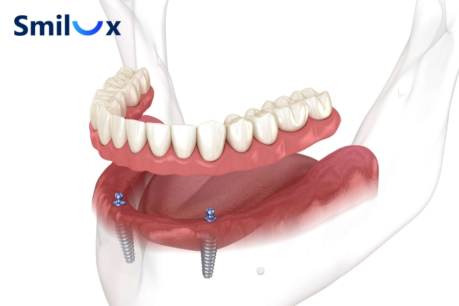 Hàm tháo lắp trên Implant giúp hàm giả chắc hơn, ăn nhai tốt hơn, ít lỏng trượt và hạn chế tiêu xương hàm Hàm tháo lắp trên Implant giúp hàm giả chắc hơn, ăn nhai tốt hơn, ít lỏng trượt và hạn chế tiêu xương hàm