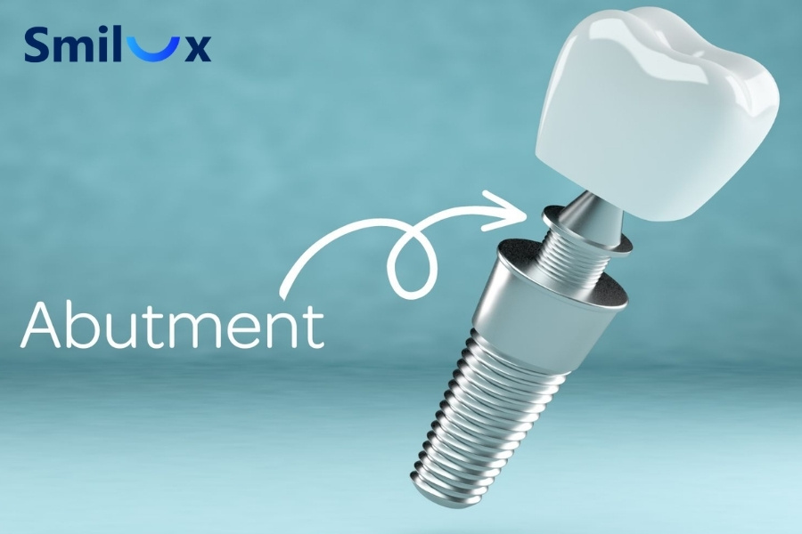 Khớp nối Abutment Khớp nối Abutment