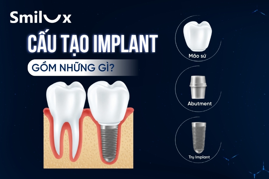 Cấu tạo Implant nha khoa như thế nào? Bác sĩ Smilux giải đáp chi tiết Cấu tạo Implant nha khoa như thế nào? Bác sĩ Smilux giải đáp chi tiết