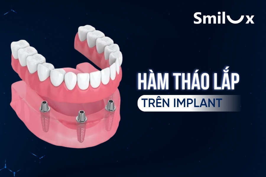 Hàm tháo lắp trên Implant là gì? Có tốt không? Giá bao nhiêu? Hàm tháo lắp trên Implant là gì? Có tốt không? Giá bao nhiêu?
